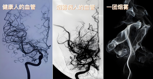 重建大腦血運 大連醫科大學附屬第二醫院為患者打通生命通道